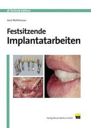 Cover von Festsitzende Implantatarbeiten